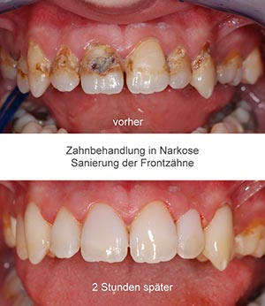 Zahnbehandlung in Narkose Vorher-Nachher-Ergebnis